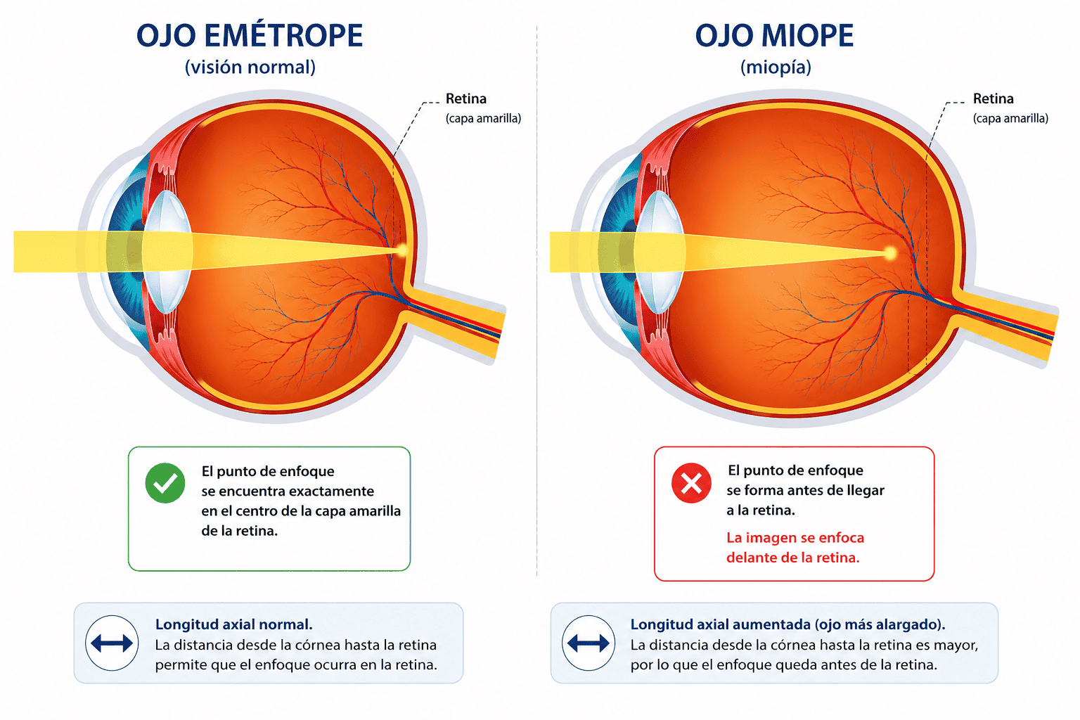 Ojo emétrope y ojo miope