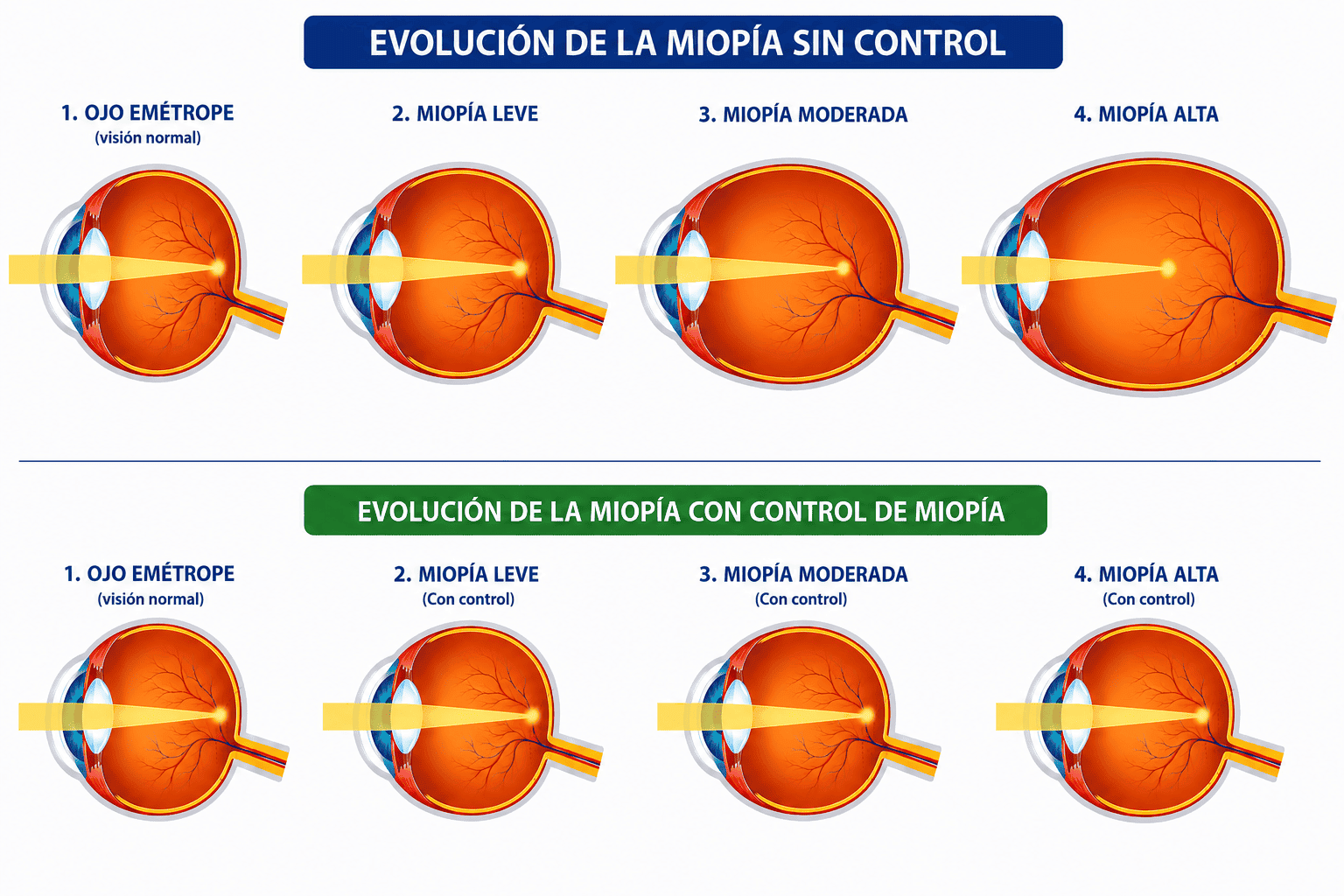 Control de miopía